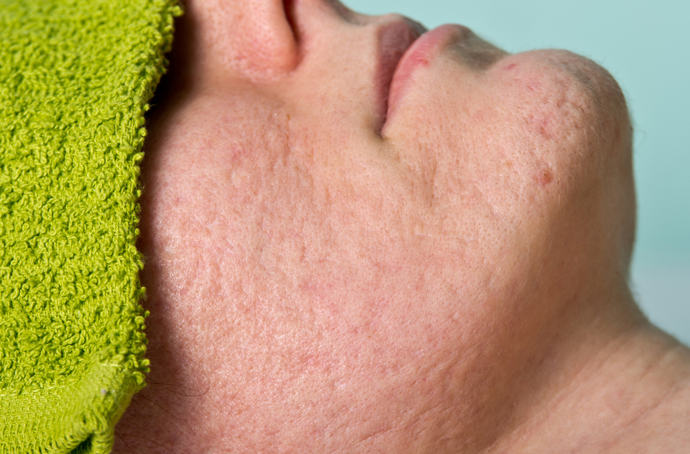 Cicatriz De Acne Cl nica Basile Ribeir o Preto